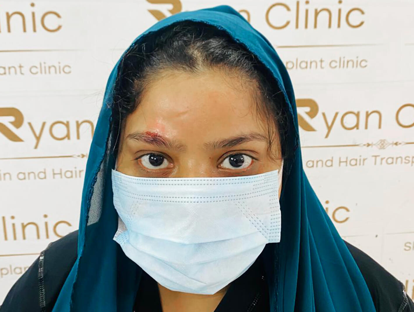 Eyebrow transplant before after